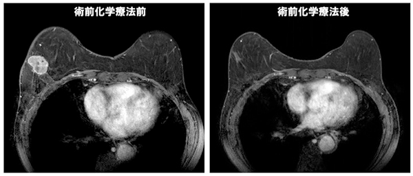 図）術前化学療法前後のMRI