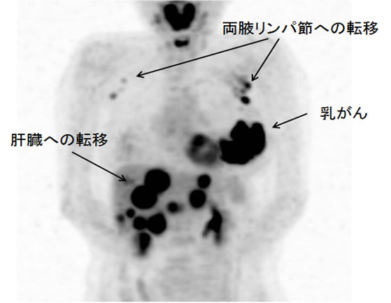 PET検査で腋のリンパ節と肝臓への転移がわかった乳がん