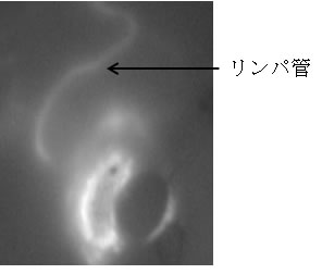 センチネルリンパ節生検の実際、色素（ICG）で蛍光を発するリンパ管