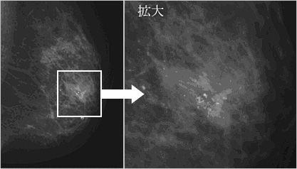 図）マンモグラフィの石灰化で発見された早期乳がん。砂粒のような白い斑点が石灰化