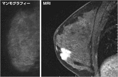 図）MRIで写し出された乳がん