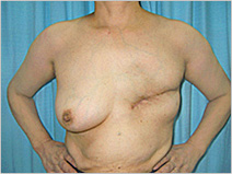 図）　乳房切除手術（左乳がん）