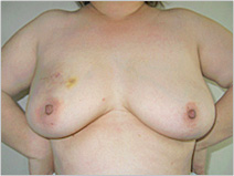 図)乳房温存手術（右乳がん）