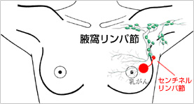 図）センチネルリンパ節