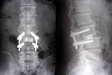 難治性の腰椎外側ヘルニアや腰椎変性すべり症に対する後側方固定術（TLIF）